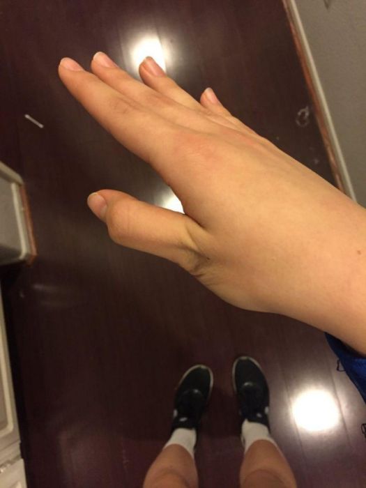 How To Dislocate Your Thumb