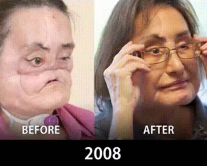 How Face Transplants Have Evolved