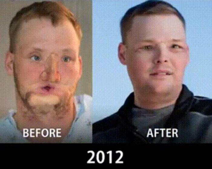 How Face Transplants Have Evolved