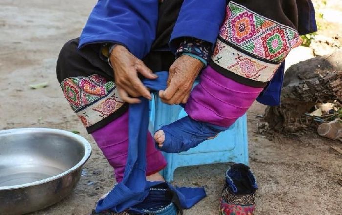 Chinese Women Who Walk With Deformed Feet