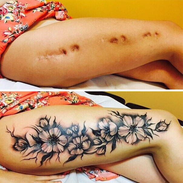 Tattoos Can Turn Scars Into Works Of Art