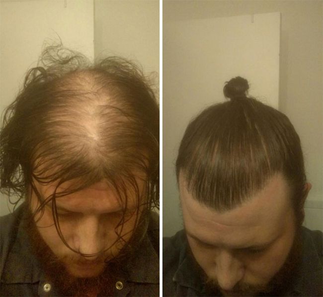 Men Are Trying To Hide Baldness With Man Buns Now