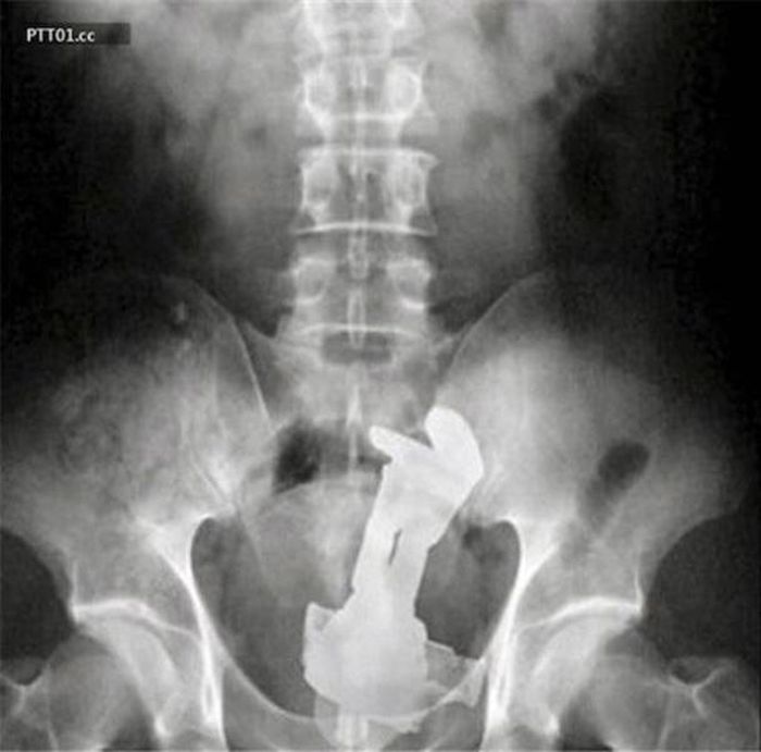 When X-Rays Reveal What You Don’t Want To See