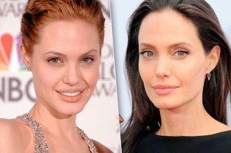 Celebrities Who Had Work Done On Their Cheekbones