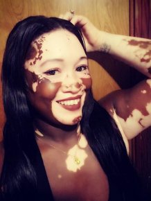 Woman With Vitiligo Becomes A Model