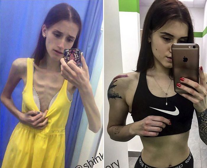Russian Teenager Beats Anorexia To Become A Fitness Instructor