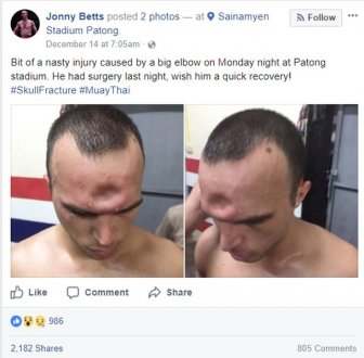 Muay Thai Fighter Suffers Horrific Injury After Getting Elbowed In The Head