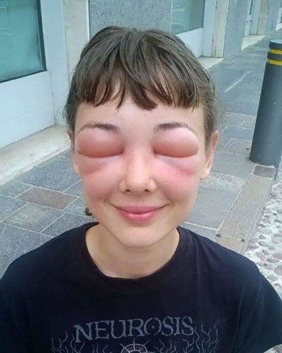 When Allergy Strikes