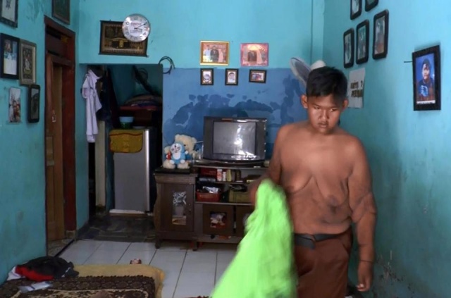 Indonesia’s Fattest Kid Lost Half His Body Weight