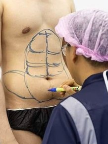 24-year-old Man Spent $4,000 On Surgery To Have Fake Stomach Muscles