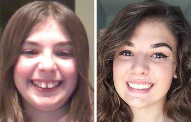 Then And Now: People Fix Their Smiles