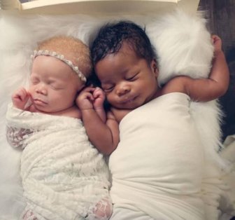 Twins With Different Skin Colors