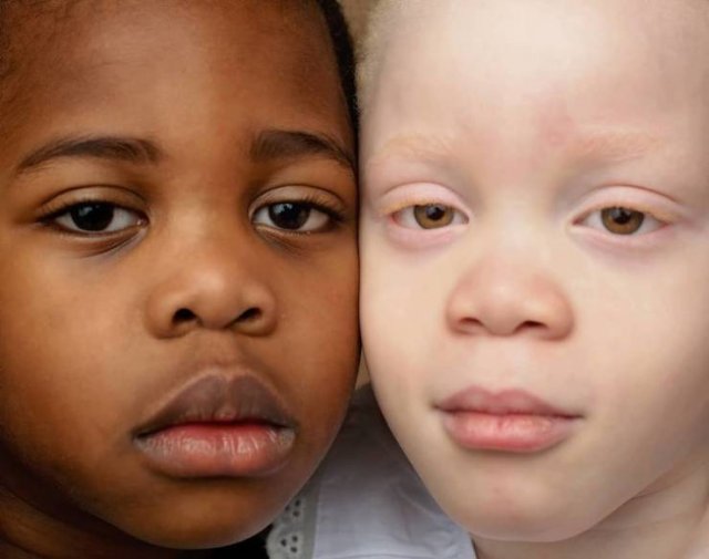 Twins With Different Skin Colors