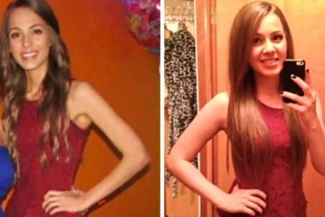 These People Won The Battle With Anorexia