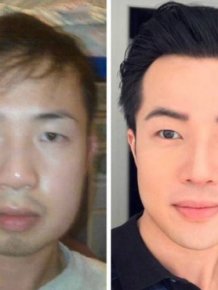 People Show Their Changes After Plastic Surgeries