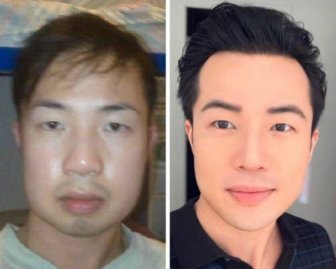 People Show Their Changes After Plastic Surgeries