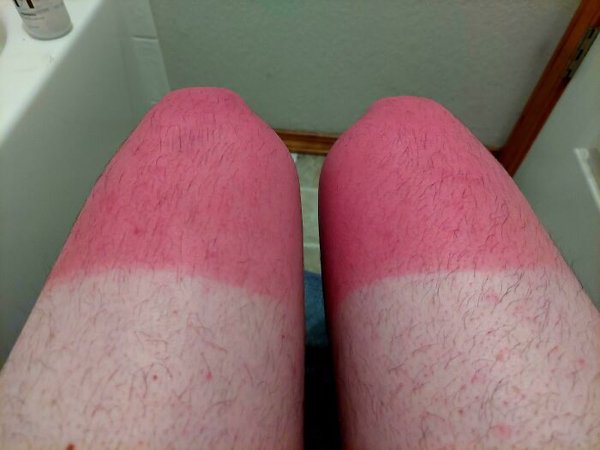 Unusual And Painful Sunburns