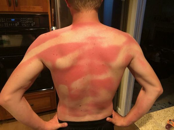 Unusual And Painful Sunburns