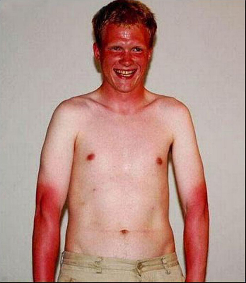 Weird And Funny Sunburns Fun