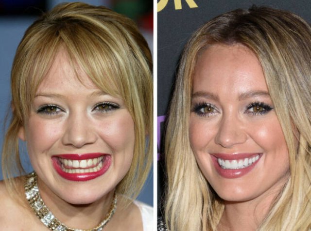 Celebrities Who Changed Their Smiles